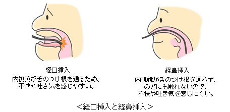 経鼻イラスト
